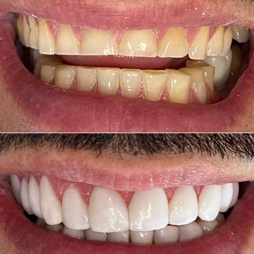 Clínica Dental Rocafort S.L. Rejuvenecimiento dental