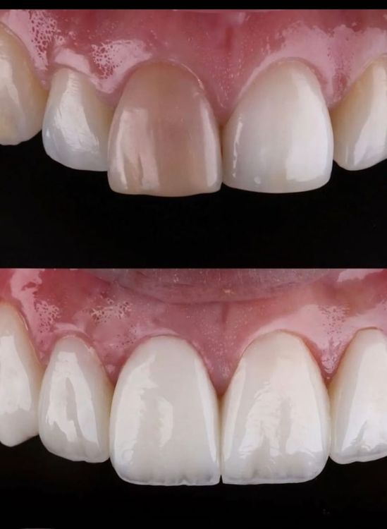 Clínica Dental Rocafort S.L. Carillas porcelana