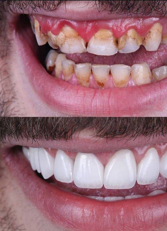 Clínica Dental Rocafort S.L. Carillas zirconio