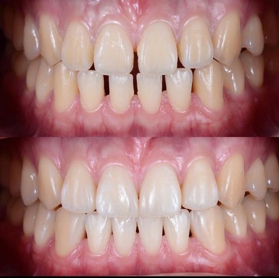 Clínica Dental Rocafort S.L. Carillas porcelana