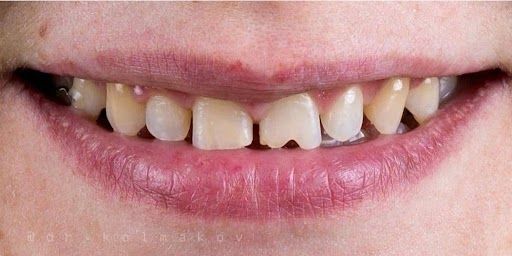 Clínica Dental Rocafort S.L. Carillas composite