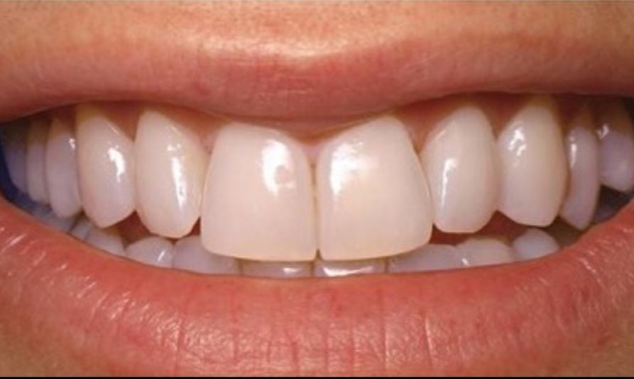 Clínica Dental Rocafort S.L. blanqueamiento dental