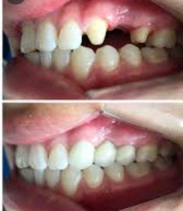 Clínica Dental Rocafort S.L. Prótesis fija