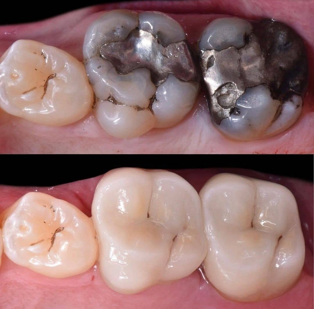 Clínica Dental Rocafort S.L. Amalgama de plata