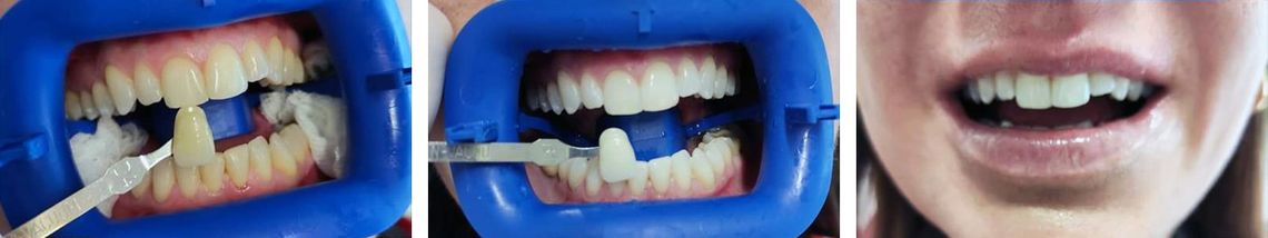 Clínica Dental Rocafort S.L. blanqueamiento dental