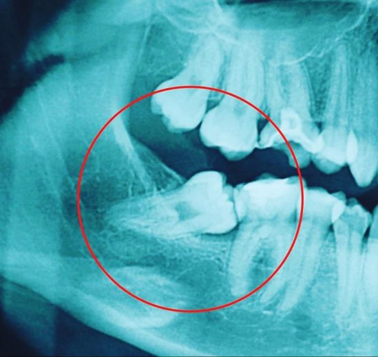 Clínica Dental Rocafort S.L. CIRUGÍA ORAL